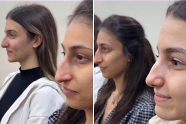 3 sestre operisale nos kod istog hirurga: Kad su videli rezultat, ljudi počeli da se hvataju za glavu (VIDEO)