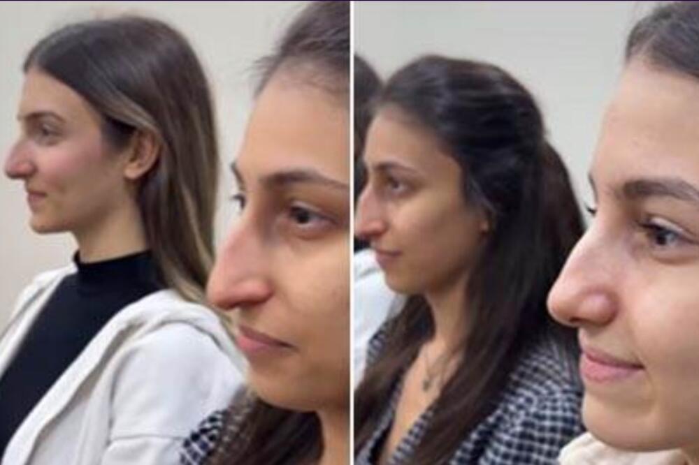 3 sestre operisale nos kod istog hirurga: Kad su videli rezultat, ljudi počeli da se hvataju za glavu (VIDEO)