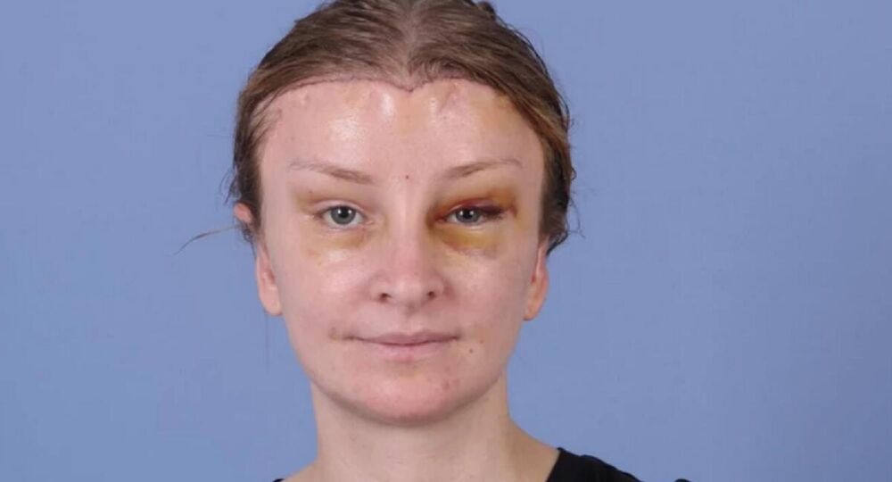 Na fotografijama se vidi da je devojci pomoću operacije spušteno čelo